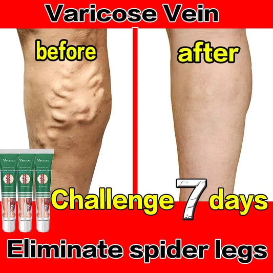 Varicose Vein Treatments Cream Effective Relieve Legs Dilated Vasculitis Phlebitis Natural Formula Ointment For Varicose Veins